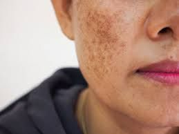 Lời khuyên chăm sóc da để ngừa thâm nám lâu dài