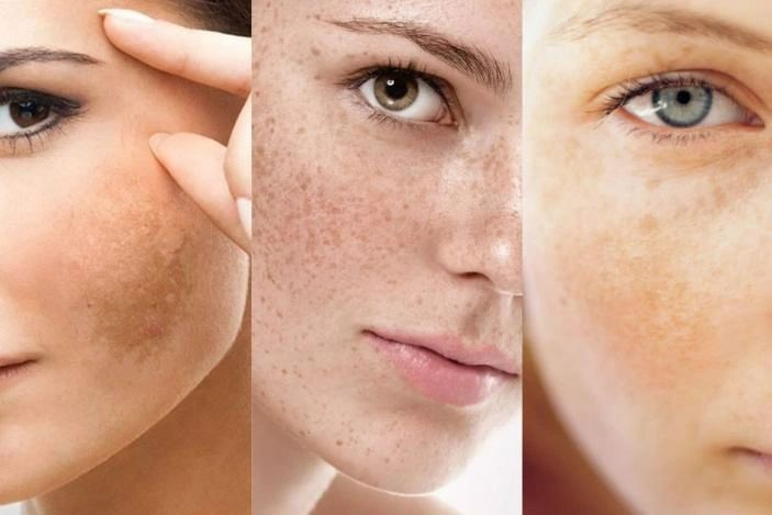 Các phương pháp làm mờ thâm nám, tàn nhang hiệu quả