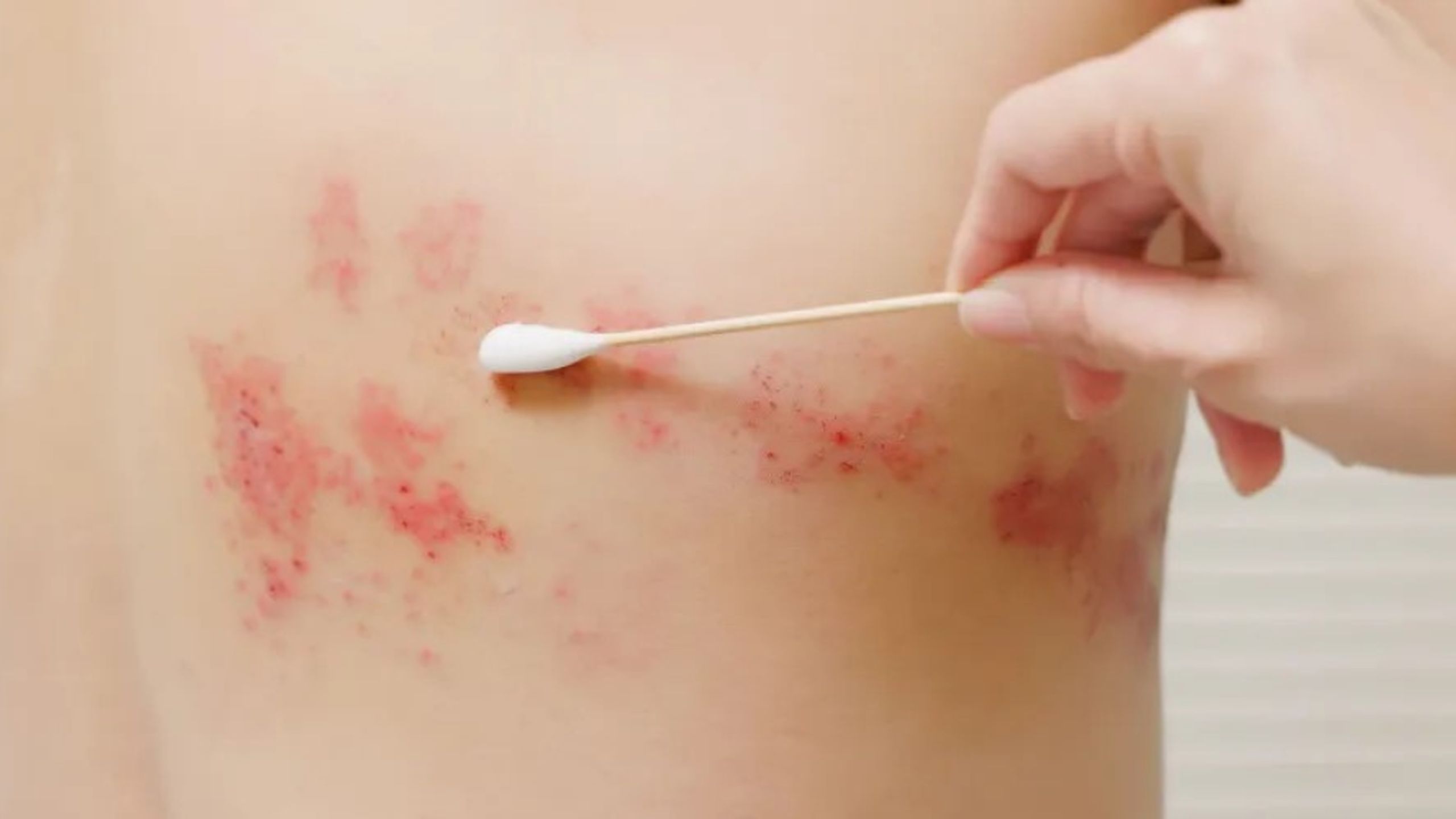 Ảnh hưởng của zona thần kinh đến làn da