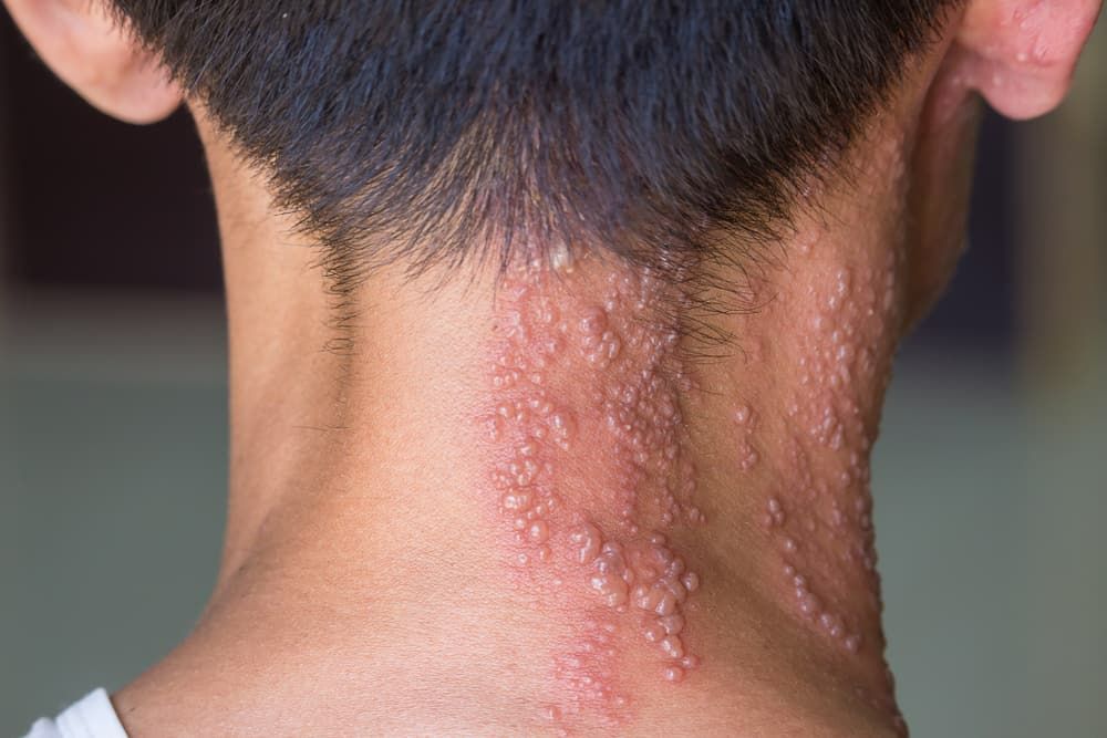 Dưỡng ẩm phục hồi da tổn thương