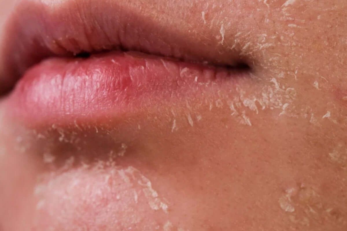 Một số câu hỏi về da khô