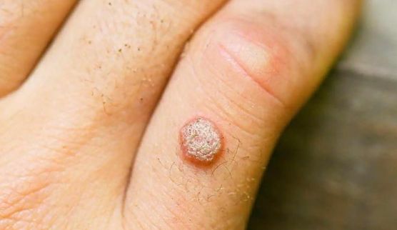 Chăm sóc và phòng ngừa mụn cóc tái phát