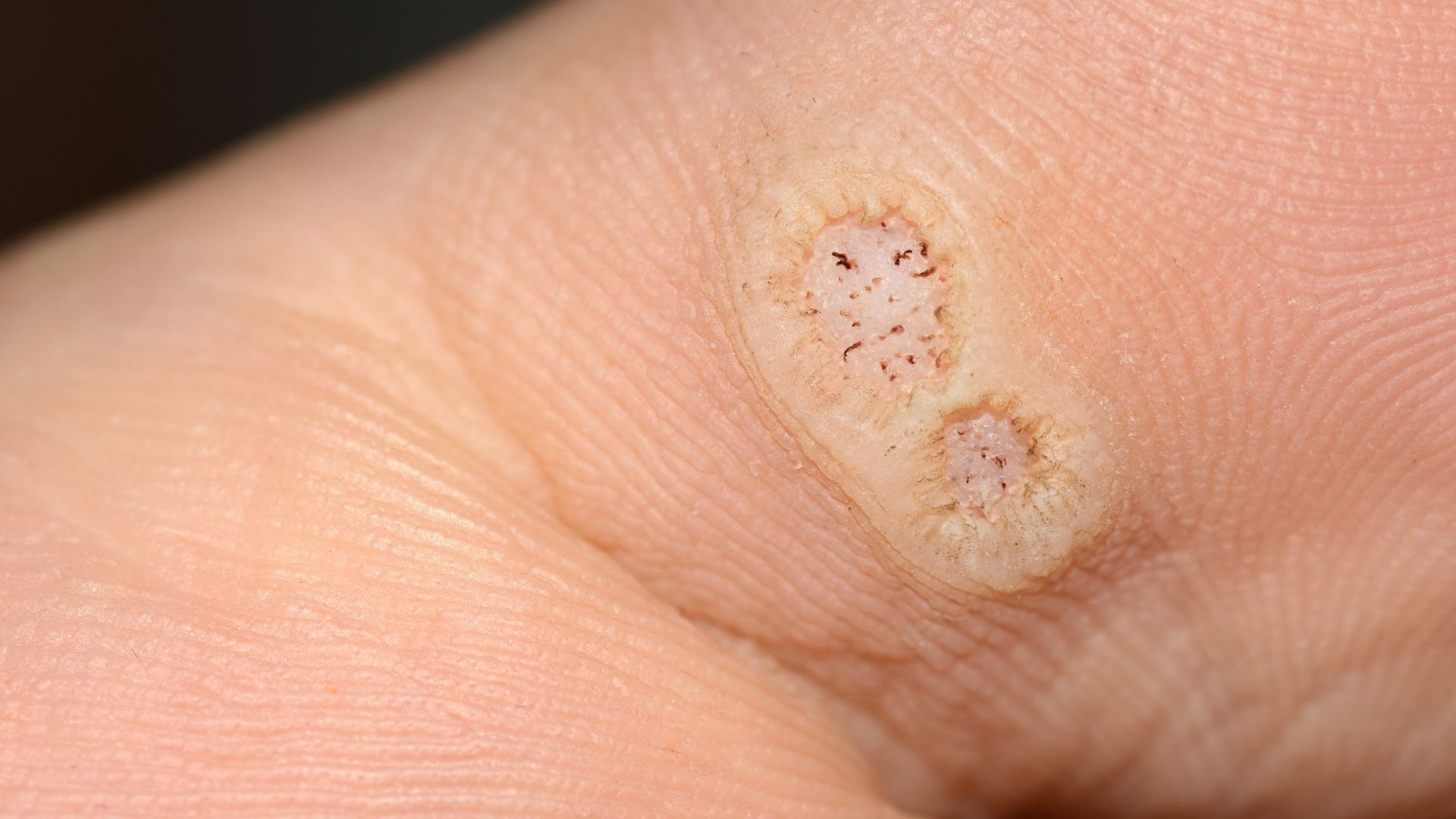 Nguyên nhân gây mụn cóc và yếu tố nguy cơ