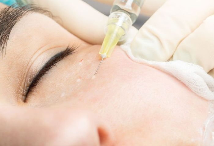 Các cách trị thâm mắt phổ biến và hiệu quả hiện nay