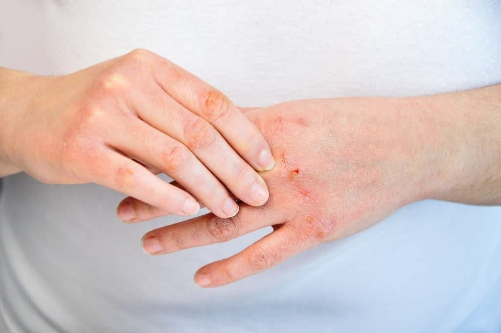 Vì sao da tay bị khô nứt khi rửa tay nhiều