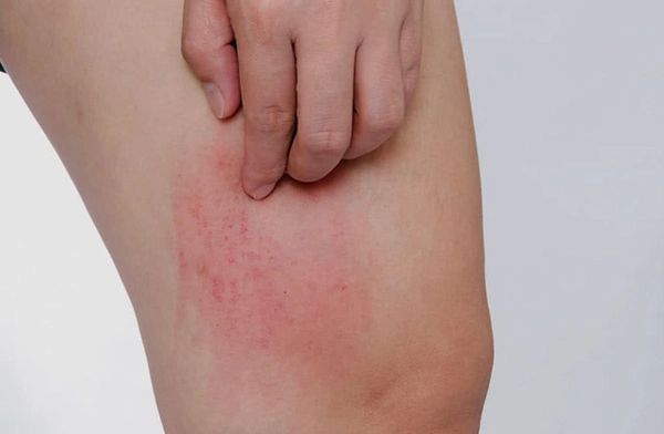 Vì sao da bị bỏng rát sau khi wax