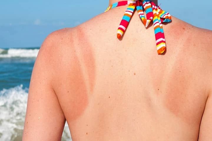 Cách nhận biết da bị cháy nắng