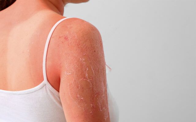 Cách làm dịu da cháy nắng nhanh trong 15–30 phút