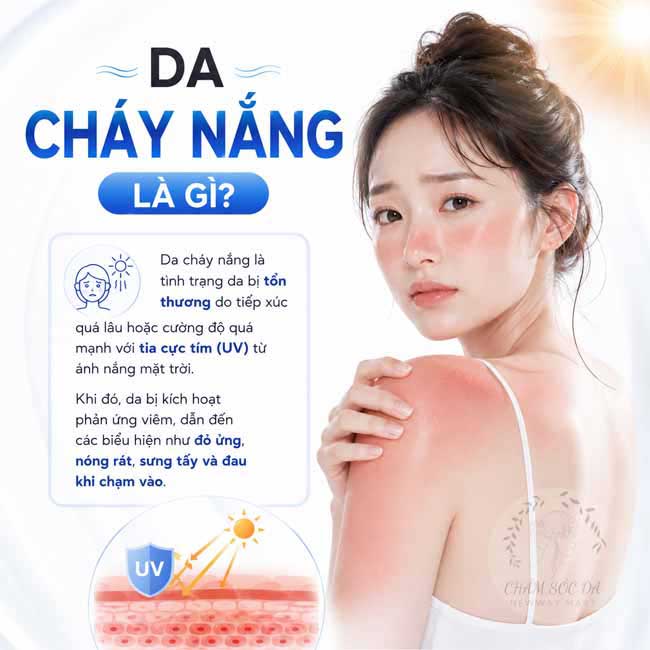 Da cháy nắng là gì?